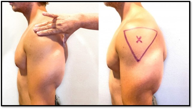 Deltoid injection site landmarks