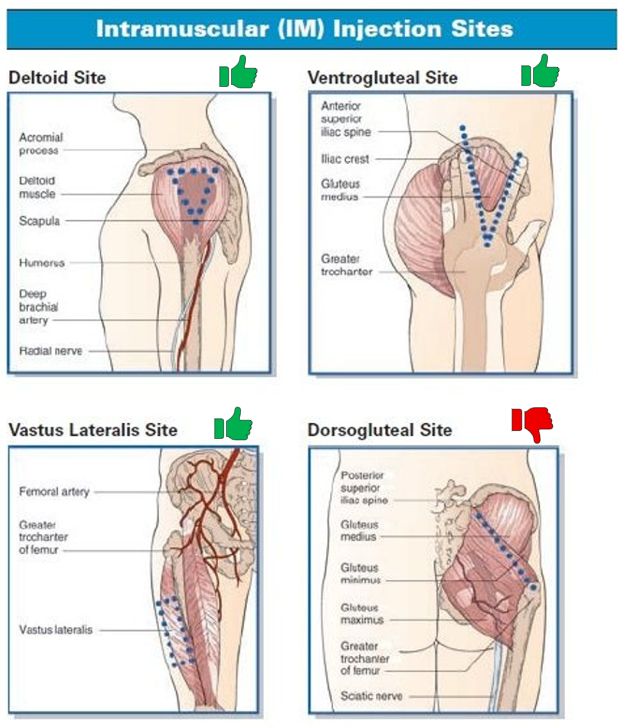 Diagram of intramuscular injection sites