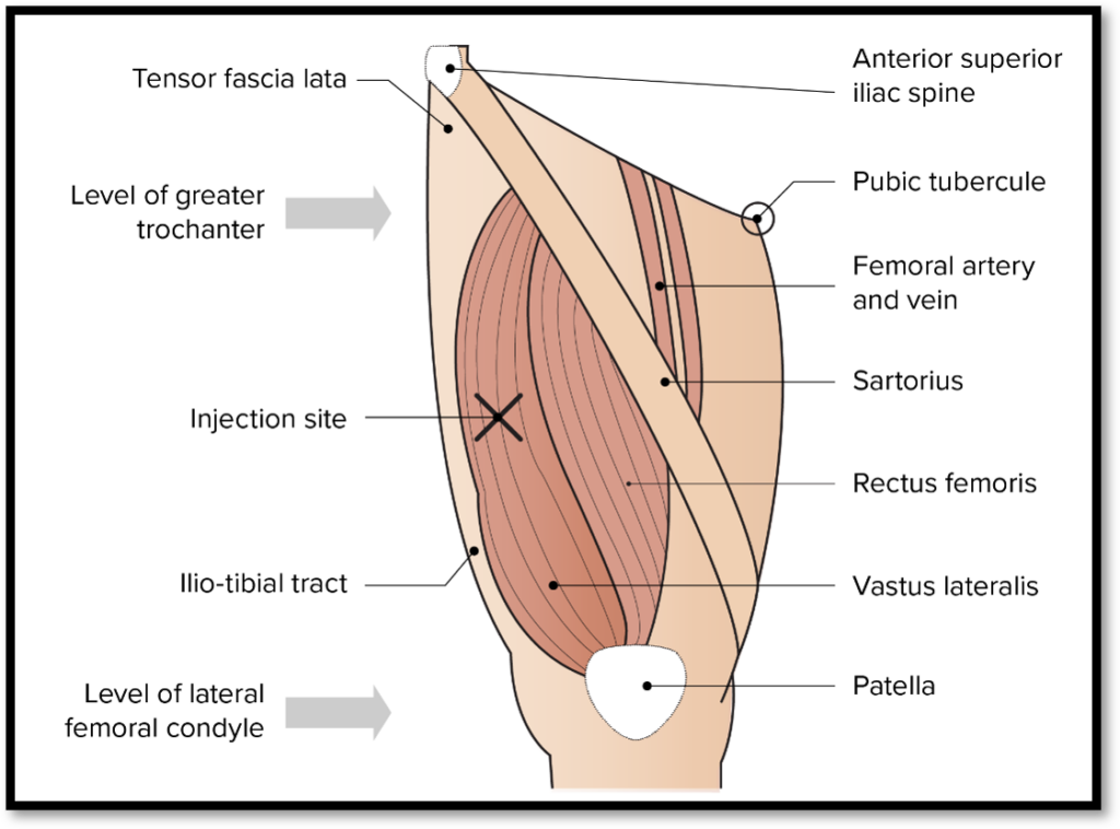 Vastus lateralis injection site landmarks