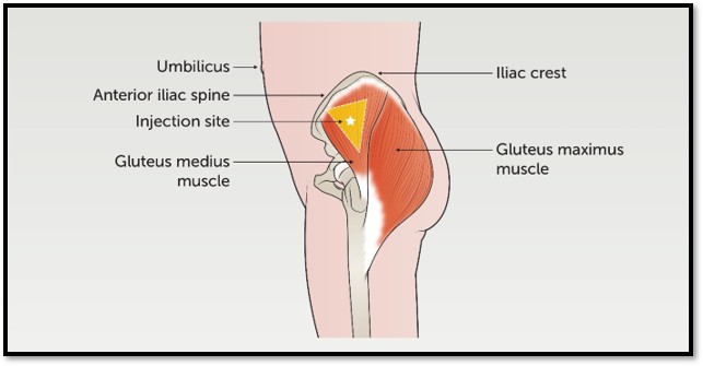Ventrogluteal injection site landmarks